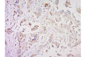 Formalin-fixed and paraffin embedded human breast cancer labeled with SMAD1 Polyclonal Antibody, Unconjugated  at 1:200 followed by conjugation to the secondary antibody and DAB staining (SMAD1 antibody  (AA 151-250))