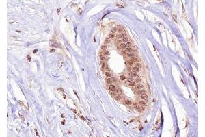 ABIN6267277 at 1/100 staining human Breast carcinoma tissue sections by IHC-P. (Estrogen Receptor alpha antibody  (pSer106))