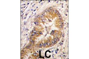 Formalin-fixed and paraffin-embedded human lung carcinoma tissue reacted with CDCA8 polyclonal antibody  , which was peroxidase-conjugated to the secondary antibody, followed by DAB staining. (CDCA8 antibody  (Internal Region))
