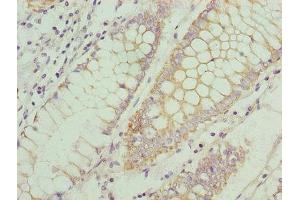 Immunohistochemistry of paraffin-embedded human colon cancer using ABIN7145914 at dilution of 1:100 (CCR1 antibody  (AA 306-355))