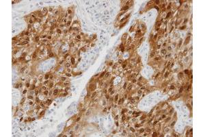 IHC-P Image Immunohistochemical analysis of paraffin-embedded lung SCC xenograft, using DDX5, antibody at 1:100 dilution. (DDX5 antibody  (C-Term))