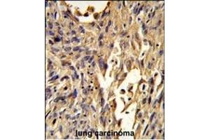 Formalin-fixed and paraffin-embedded human lung carcinoma reacted with S100A10 Antibody (Center), which was peroxidase-conjugated to the secondary antibody, followed by DAB staining. (S100A10 antibody  (AA 12-40))