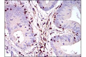 Immunohistochemical analysis of paraffin-embedded colon cancer tissues using PTPRC mouse mAb with DAB staining.