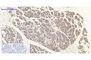 Immunohistochemistry of paraffin-embedded Human stomach cancer tissue with Phospho-FAK (Tyr397) Polyclonal Antibody at dilution of 1:200 (FAK antibody  (pTyr397))