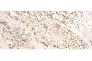Immunohistochemistry of paraffin-embedded Human gastric cancer tissue using DMTN Polyclonal Antibody at dilution of 1:35(x200) (Dematin antibody)