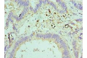 Immunohistochemistry of paraffin-embedded human colon cancer using ABIN7151593 at dilution of 1:100 (TCEB2 antibody  (AA 1-118))