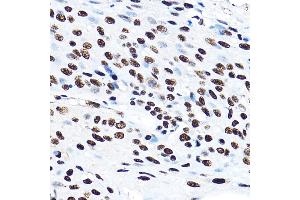 Immunohistochemistry of paraffin-embedded human esophageal cancer using SF3 Rabbit pAb (ABIN1682671, ABIN3018959, ABIN3018960 and ABIN6220644) at dilution of 1:100 (40x lens). (SF3A3 antibody  (AA 292-501))