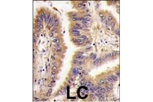 Formalin-fixed and paraffin-embedded human lung carcinoma tissue reacted with *TGM2 antibody (Center ), which was peroxidase-conjugated to the secondary antibody, followed by DAB staining. (Transglutaminase 2 antibody  (AA 429-458))