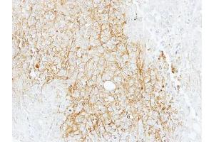 IHC-P Image Immunohistochemical analysis of paraffin-embedded AGS xenograft, using BSEP, antibody at 1:100 dilution. (ABCB11 antibody  (Internal Region))