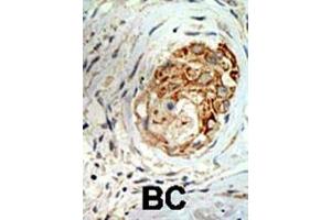 Formalin-fixed and paraffin-embedded human cancer tissue reacted with the primary antibody, which was peroxidase-conjugated to the secondary antibody, followed by DAB staining. (MBD3 antibody  (C-Term))