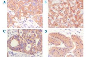 Immunohistochemical analysis of paraffin-embedded human lung squamous cell carcinoma (A) ,normal hepatocyte (B) , colon adenocacinoma, normal stomach tissue (D) , showing cytoplasmic and membrane localization using KRT5 monoclonal antibody, clone 7H8  with DAB staining. (Cytokeratin 5 antibody)