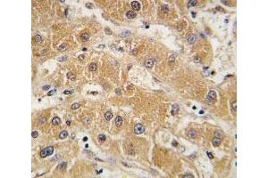 IHC analysis of FFPE human hepatocarcinoma tissue stained with APOA5 antibody (APOA5 antibody  (AA 22-52))