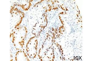 IHC staining of human lung adenocarcinoma (10X) with TTF-1 antibody (8G7G3/1). (TTF1 antibody)