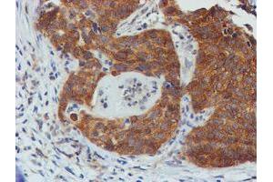 Immunohistochemical staining of paraffin-embedded Carcinoma of Human lung tissue using anti-TULP3 mouse monoclonal antibody.