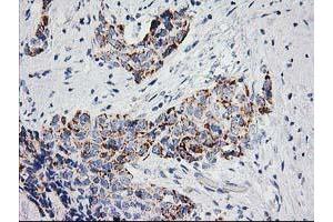 Immunohistochemical staining of paraffin-embedded Adenocarcinoma of Human breast tissue using anti-PPM1B mouse monoclonal antibody. (PPM1B antibody)