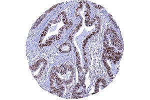 Colon Colorectal adenocarcinoma showing strong MSH6 positivity in cancer cells and moderate staining in stromal cells (Recombinant MSH6 antibody  (AA 1-100))