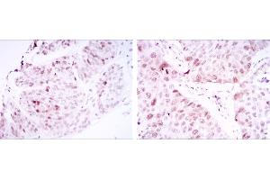Immunohistochemical analysis of paraffin-embedded ovarian cancer tissues (left) and lung cancer tissues (right) using CDK1 mouse mAb with DAB staining. (CDK1 antibody)