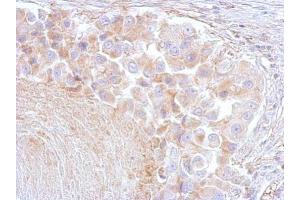 IHC-P Image Annexin VI antibody [C2C3], C-term detects ANXA6 protein at cytosol on human breast by immunohistochemical analysis. (ANXA6 antibody  (C-Term))