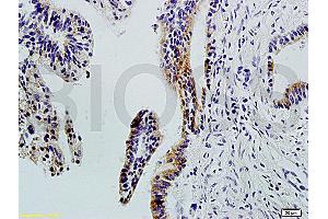 Formalin-fixed and paraffin-embedded : human colon carcinoma labeled with Rabbit Anti-Integrin ? (ITGAV/ITGB1 antibody)