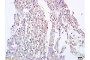 Formalin-fixed and paraffin embedded human lung carcinoma labeled with Anti-BRLF1 Polyclonal Antibody, Unconjugated (ABIN873254) at 1:200 followed by conjugation to the secondary antibody and DAB staining. (Protein Rta/BRLF1 antibody  (AA 81-180))