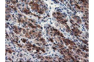 Immunohistochemical staining of paraffin-embedded Carcinoma of Human liver tissue using anti-SEC14L2 mouse monoclonal antibody.