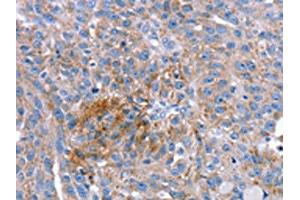 The image on the left is immunohistochemistry of paraffin-embedded Human breast cancer tissue using ABIN7192628(SPATA5L1 Antibody) at dilution 1/20, on the right is treated with synthetic peptide. (SPATA5L1 antibody)