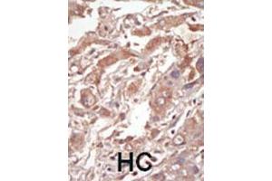 Formalin-fixed and paraffin-embedded human cancer tissue reacted with the primary antibody, which was peroxidase-conjugated to the secondary antibody, followed by DAB staining. (STK10-A antibody  (C-Term))