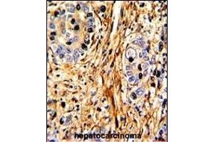 Formalin-fixed and paraffin-embedded human hepatocarcinoma with LB2 Antibody (C-term), which was peroxidase-conjugated to the secondary antibody, followed by DAB staining. (LAMB2 antibody  (C-Term))