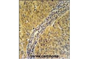 DYNC1LI2 Antibody (Center) (ABIN651669 and ABIN2840352) immunohistochemistry analysis in formalin fixed and paraffin embedded human cervix carcinoma followed by peroxidase conjugation of the secondary antibody and DAB staining. (DYNC1LI2 antibody  (AA 152-180))