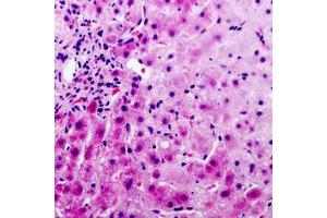 Immunohistochemical analysis of PAI3 staining in human liver cancer formalin fixed paraffin embedded tissue section.