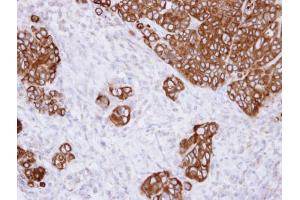 IHC-P Image Immunohistochemical analysis of paraffin-embedded SW480 xenograft , using alpha Glucosidase II, antibody at 1:500 dilution. (GANAB antibody  (N-Term))