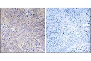 Immunohistochemistry analysis of paraffin-embedded human cervix carcinoma tissue, using MRPL11 Antibody. (MRPL11 antibody  (AA 21-70))
