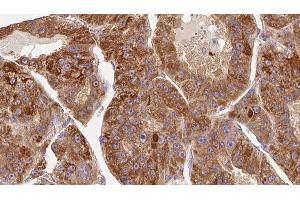 ABIN6276768 at 1/100 staining Human liver cancer tissue by IHC-P. (KIR3DL1 antibody  (Internal Region))