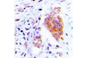 Immunohistochemical analysis of CDC37 (pS13) staining in human lung cancer formalin fixed paraffin embedded tissue section. (CDC37 antibody  (N-Term, pSer13))