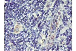 Immunohistochemical staining of paraffin-embedded Human lymphoma tissue using anti-DPP9 mouse monoclonal antibody.