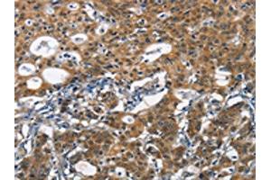 The image on the left is immunohistochemistry of paraffin-embedded Human gastic cancer tissue using ABIN7190434(DCC Antibody) at dilution 1/70, on the right is treated with synthetic peptide.