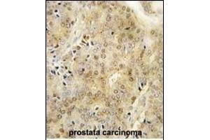 Formalin-fixed and paraffin-embedded human prostata carcinoma tissue reacted with EZH1 Antibody (Center) (ABIN389082 and ABIN2839279) , which was peroxidase-conjugated to the secondary antibody, followed by DAB staining. (EZH1 antibody  (AA 393-422))