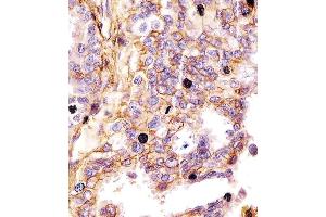 (ABIN659120 and ABIN2843760) staining CD44 in human lung adenocarcinoma tissue sections by Immunohistochemistry (IHC-P - paraformaldehyde-fixed, paraffin-embedded sections). (CD44 antibody)