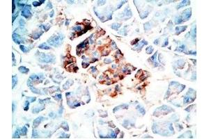 Human pancreas cancer tissue was stained by Rabbit Anti-Oxyntomodulin (H,M,R) Antibody (OXM antibody)