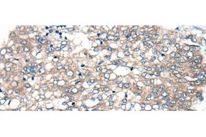 Immunohistochemistry of paraffin-embedded Human liver cancer tissue using BBS12 Polyclonal Antibody at dilution of 1:50(x200) (BBS12 antibody)