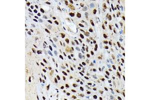 Immunohistochemistry of paraffin-embedded human esophageal cancer using ENT2/SLC29 Rabbit mAb (ABIN7270448) at dilution of 1:100 (40x lens). (SLC29A2 antibody)