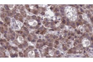 ABIN6273919 at 1/100 staining Human liver cancer tissue by IHC-P. (F4/80 antibody  (C-Term))