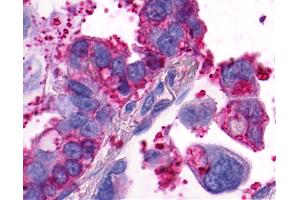 Anti-GPR4 antibody IHC of human Lung, Adenocarcinoma. (GPR4 antibody  (Extracellular Domain))