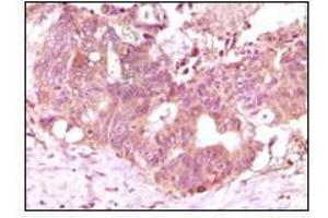 Immunohistochemical analysis of paraffin-embedded human recturn adenocarcinoma tissue showing cytoplasmic localization using FGF2 antibody with DAB staining. (FGF2 antibody)