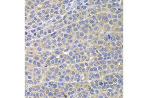 Immunohistochemistry of paraffin-embedded mouse cancer using STAT4 antibody at dilution of 1:100 (x400 lens). (STAT4 antibody)