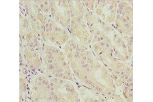 Immunohistochemistry of paraffin-embedded human gastric cancer using ABIN7144962 at dilution of 1:100 (DDX11 antibody  (AA 1-220))