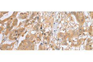 Immunohistochemistry of paraffin-embedded Human breast cancer tissue using MOB4 Polyclonal Antibody at dilution of 1:25(x200) (MOBKL3 antibody)