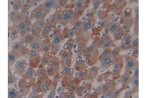 Detection of MBL in Human Liver cancer Tissue using Polyclonal Antibody to Mannose Binding Lectin (MBL) (MBL2 antibody  (AA 130-248))