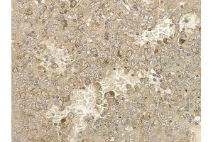 ABIN6256612 and ABIN6267176 at 1/100 staining human melanoma by IHC-P. (INPP5D antibody  (pTyr1020, pTyr1022))