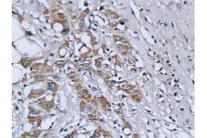 Formalin-fixed and paraffin embedded human breast cancer labeled with Anti-Ets1/ETS-1 Polyclonal Antibody, Unconjugated (ABIN674424) followed by conjugation to the secondary antibody and DAB staining (ETS1 antibody  (AA 321-441))
